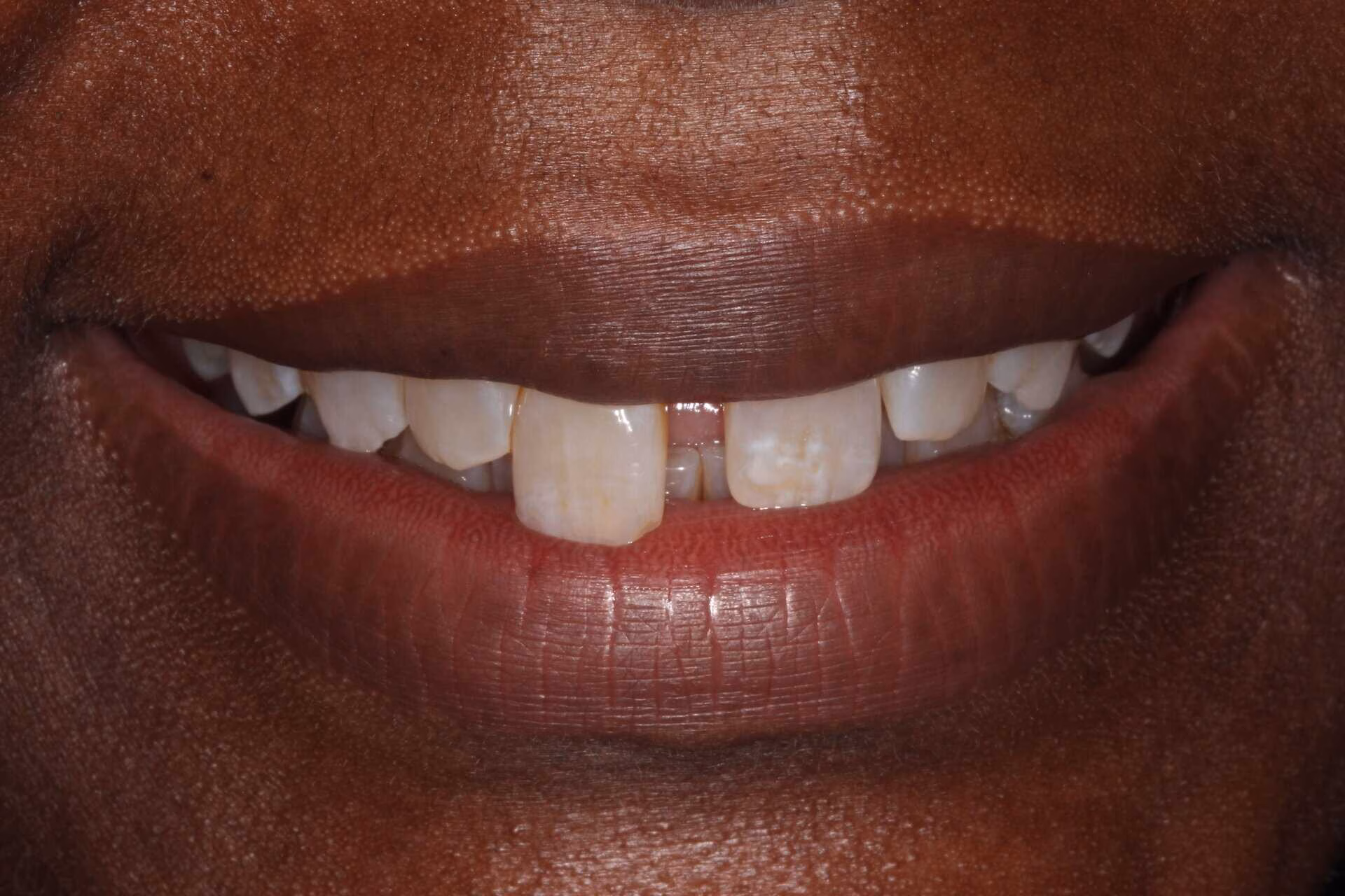 composite bonding patient 4 before composite bonding treatment