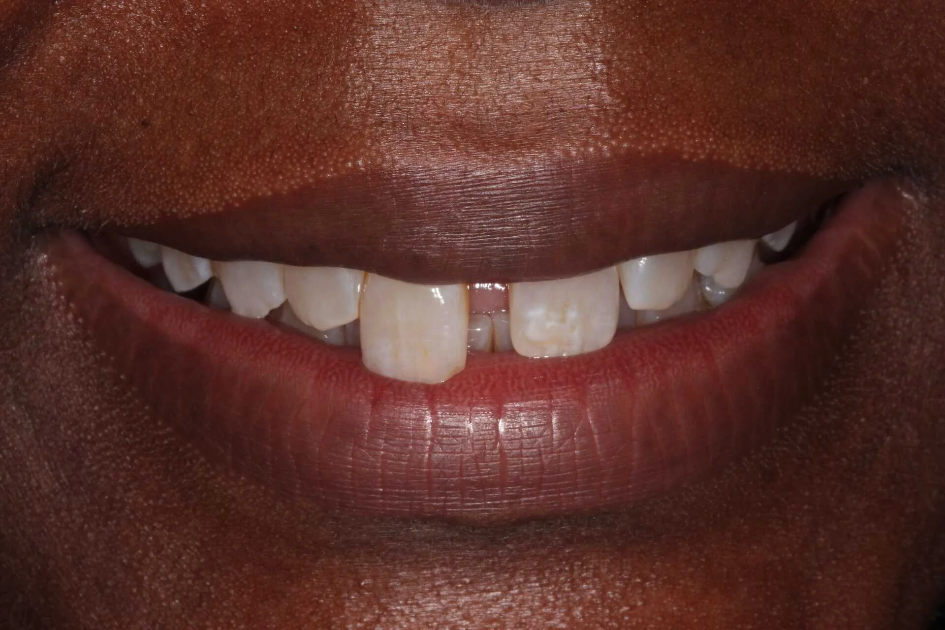 composite bonding patient 4 before composite bonding treatment