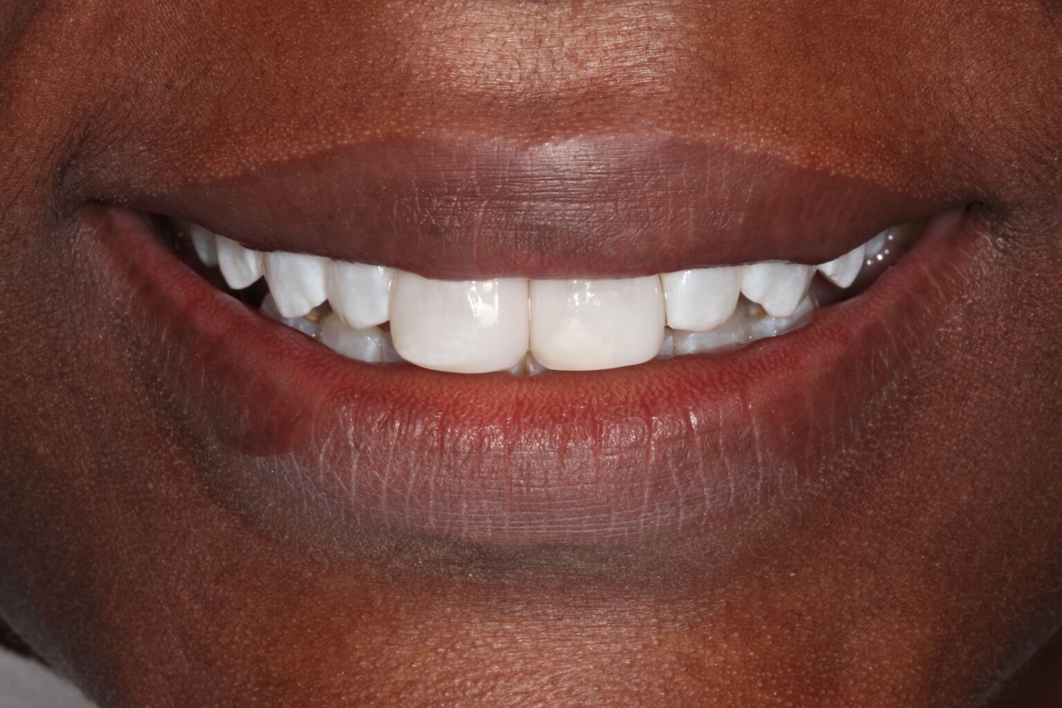 Teeth Straightening & Orthodontics Milton Keynes Beyond Dental