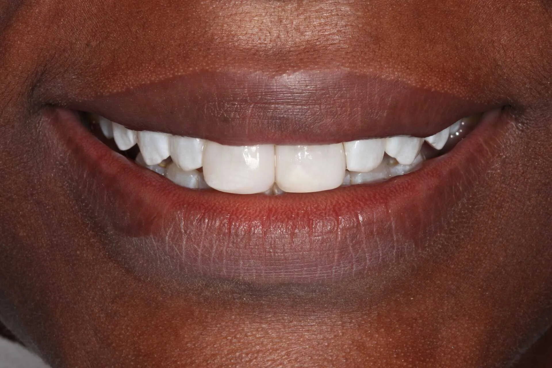 composite bonding patient 3 after composite bonding treatment