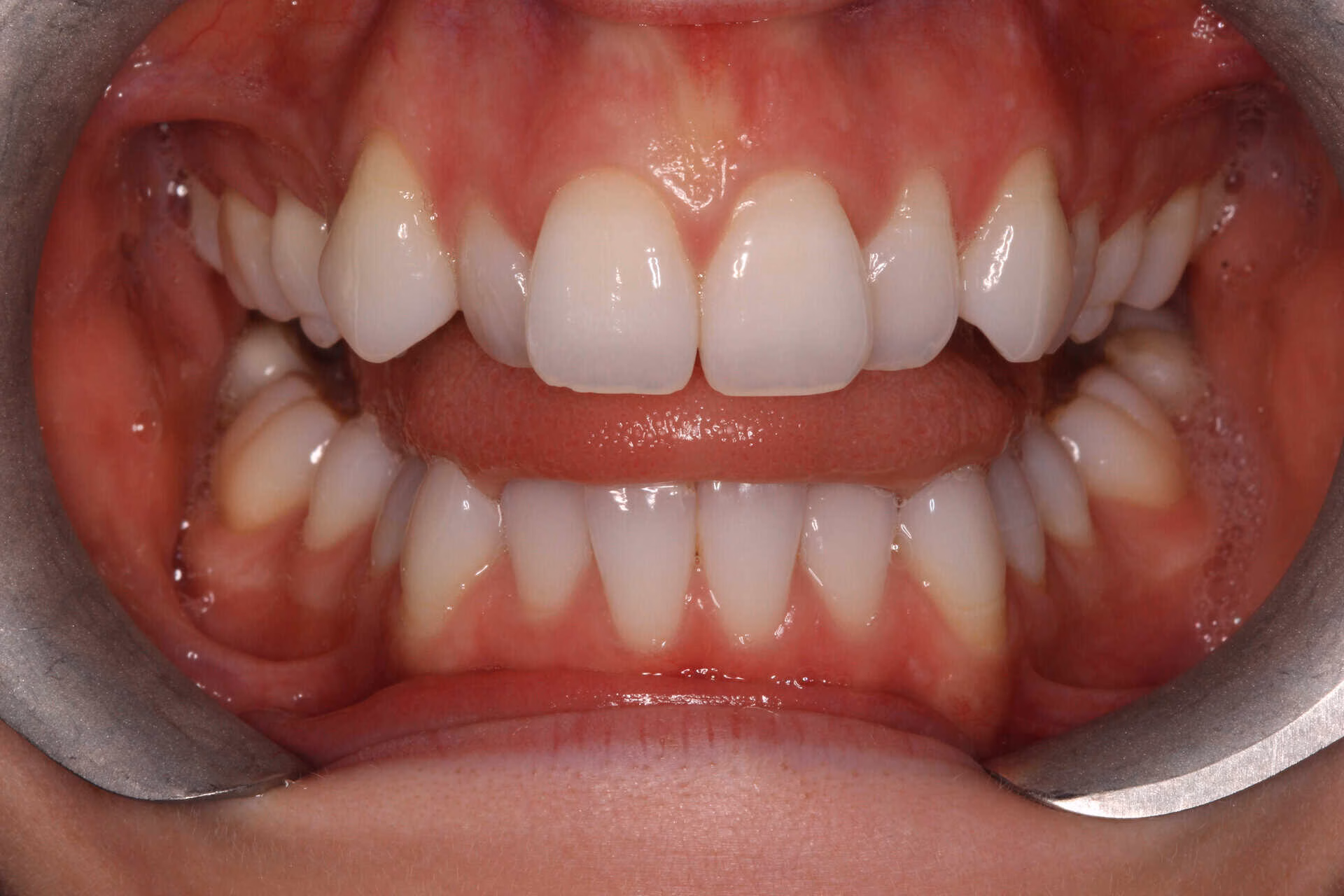 invisalign patient before treatment