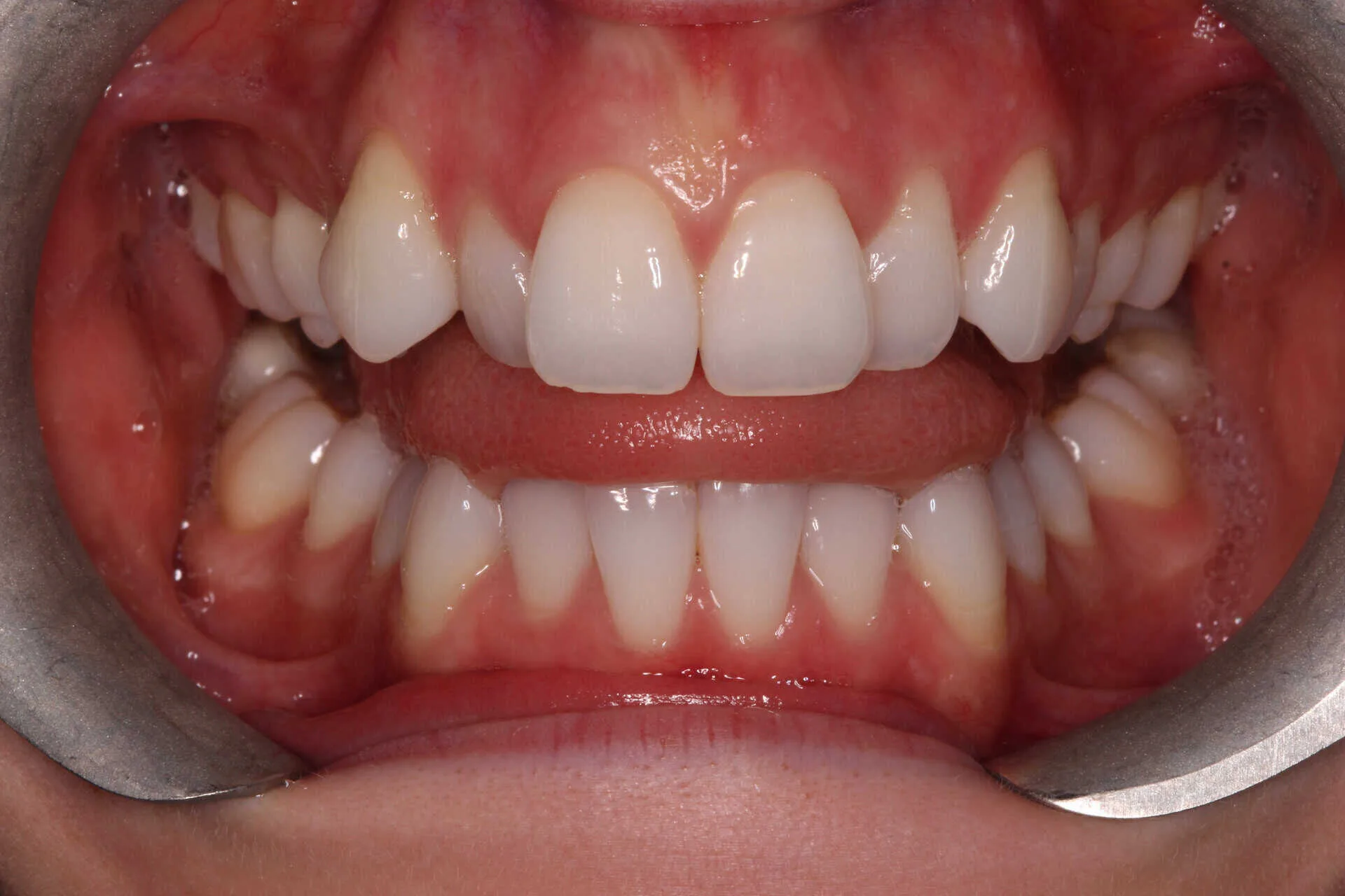 invisalign patient before treatment