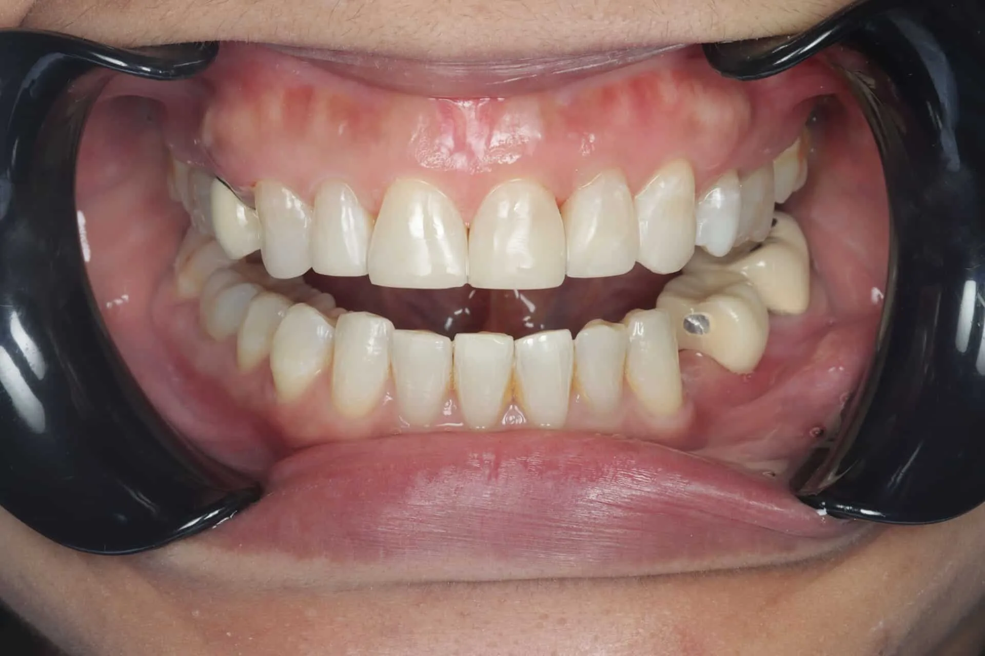 Composite bonding patient post composite bonding treatment