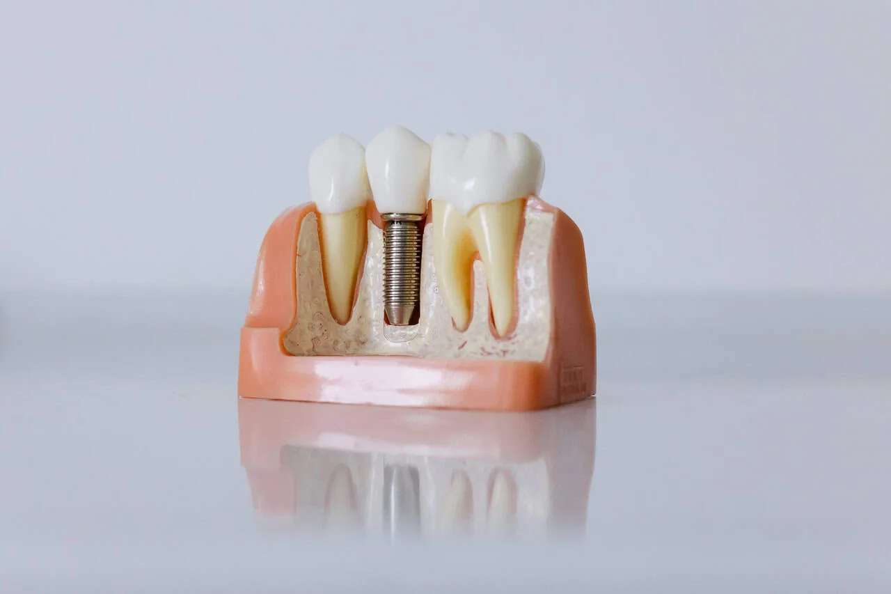 Dental implants model showing implant