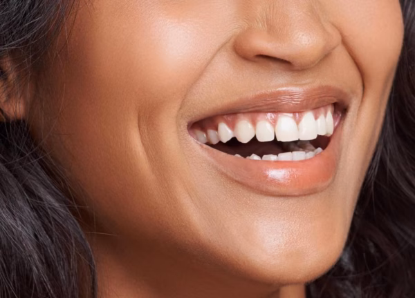 Leamington Spa- Teeth Stain Removal