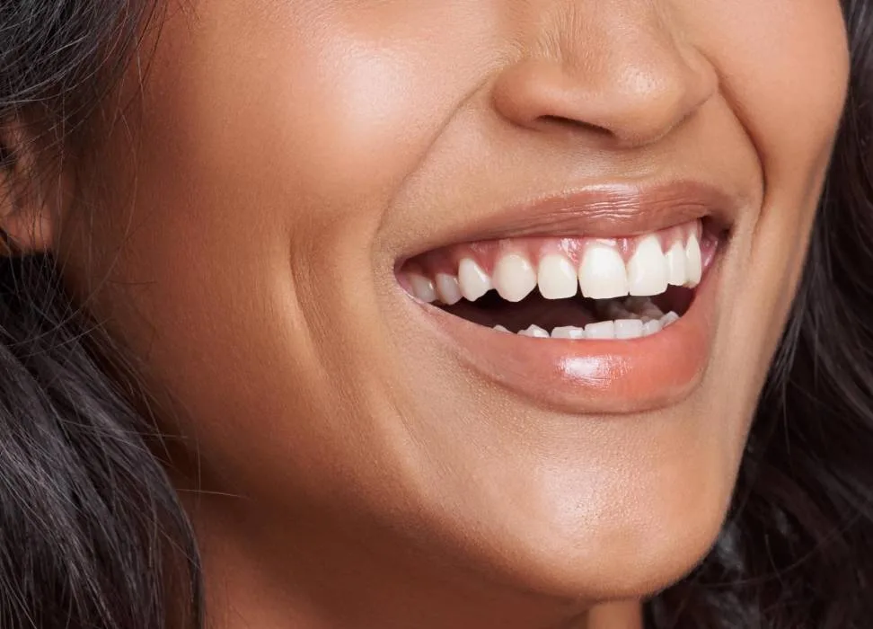 RS_Invisalign-1