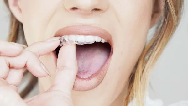 Invisalign