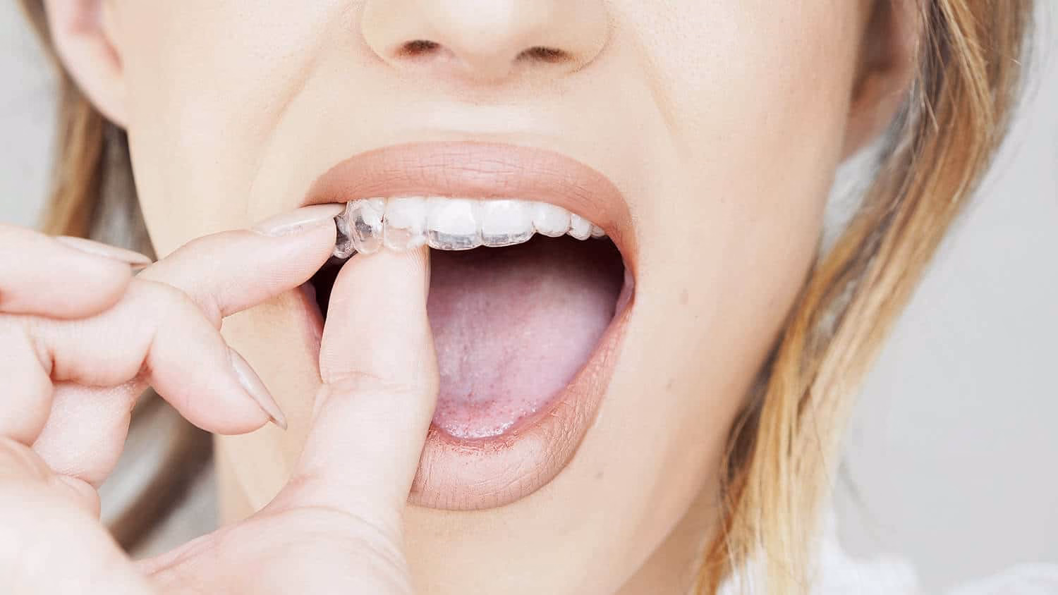 Invisalign-clear-braces-beyond-dental