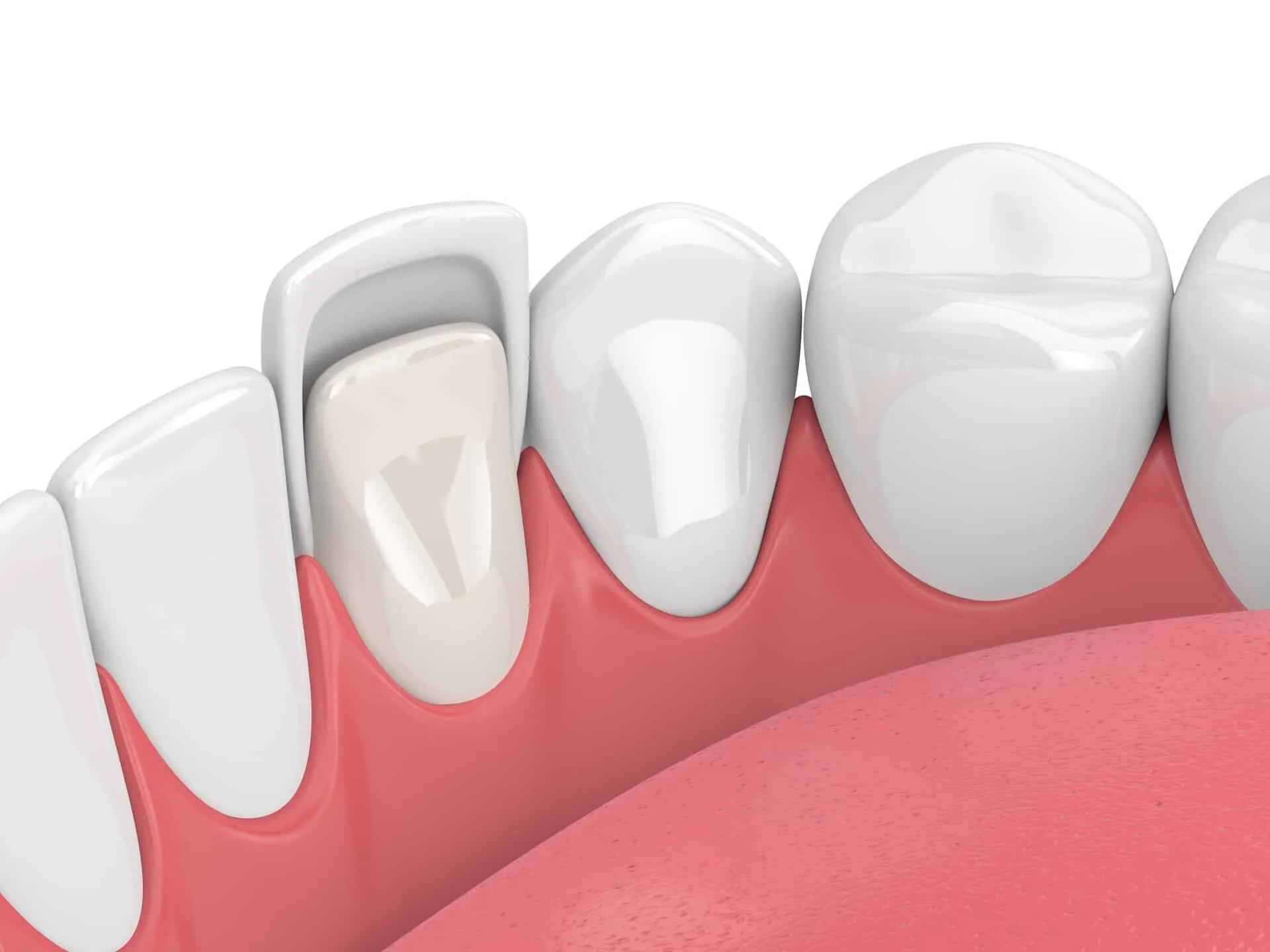 how composite veneers work