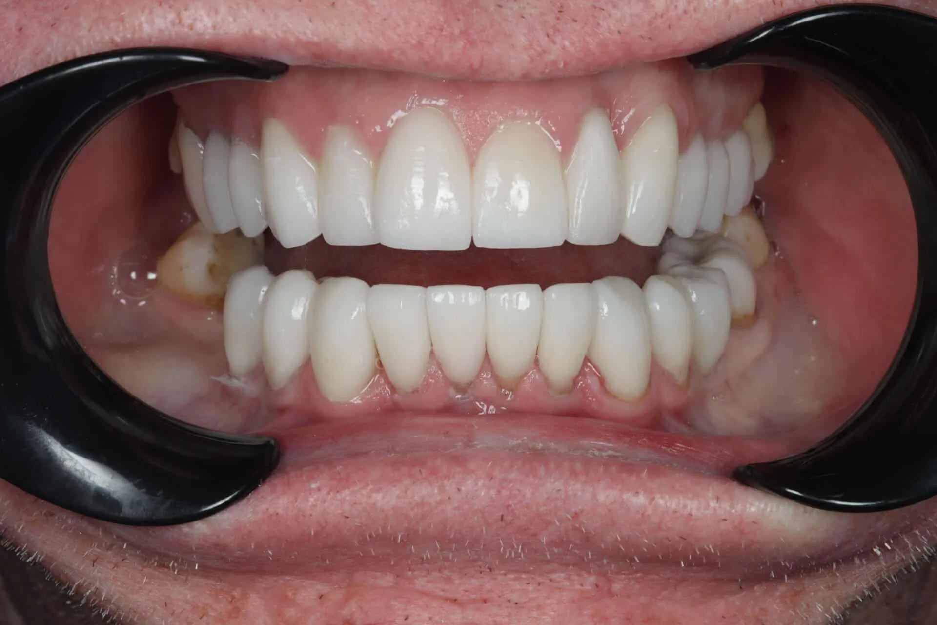Porcelain Veneers After