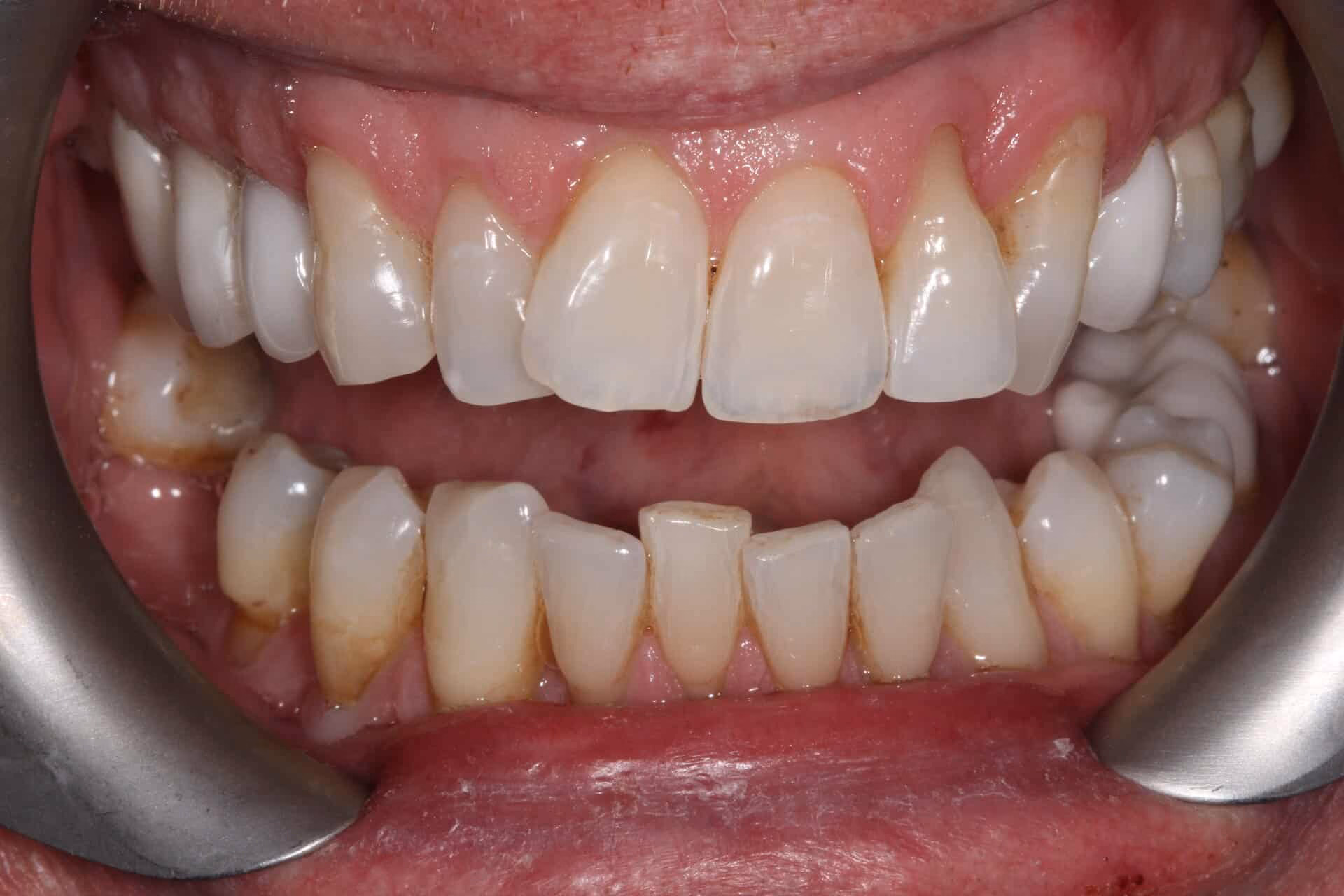 Porcelain Venners Before