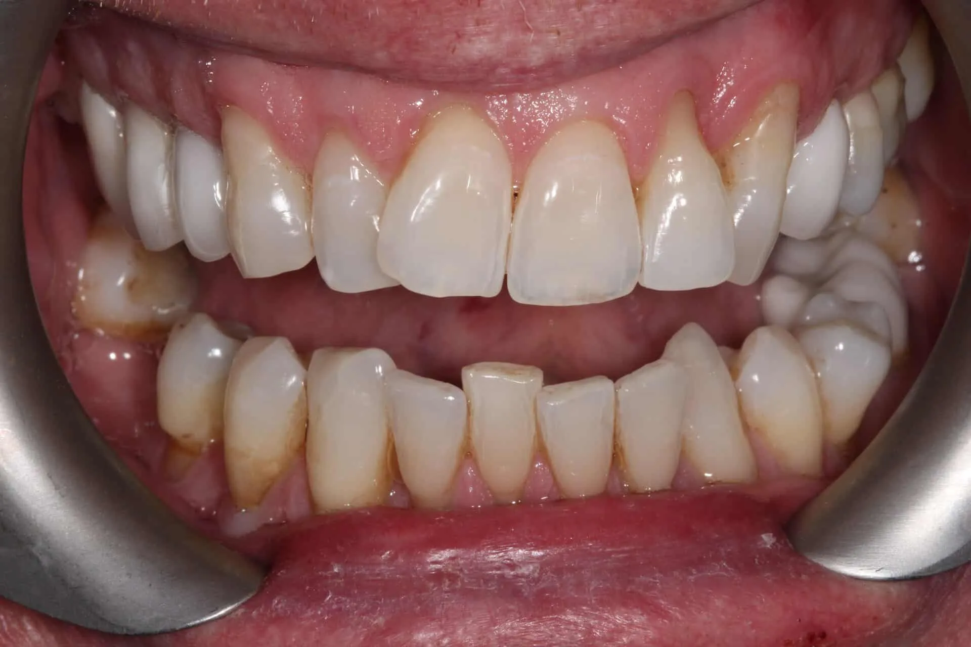 Porcelain Venners Before