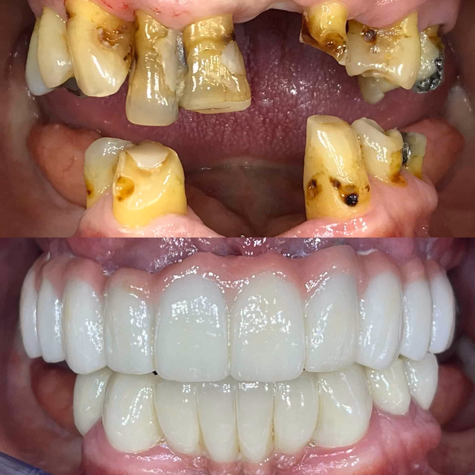 All on four before and after dental implants