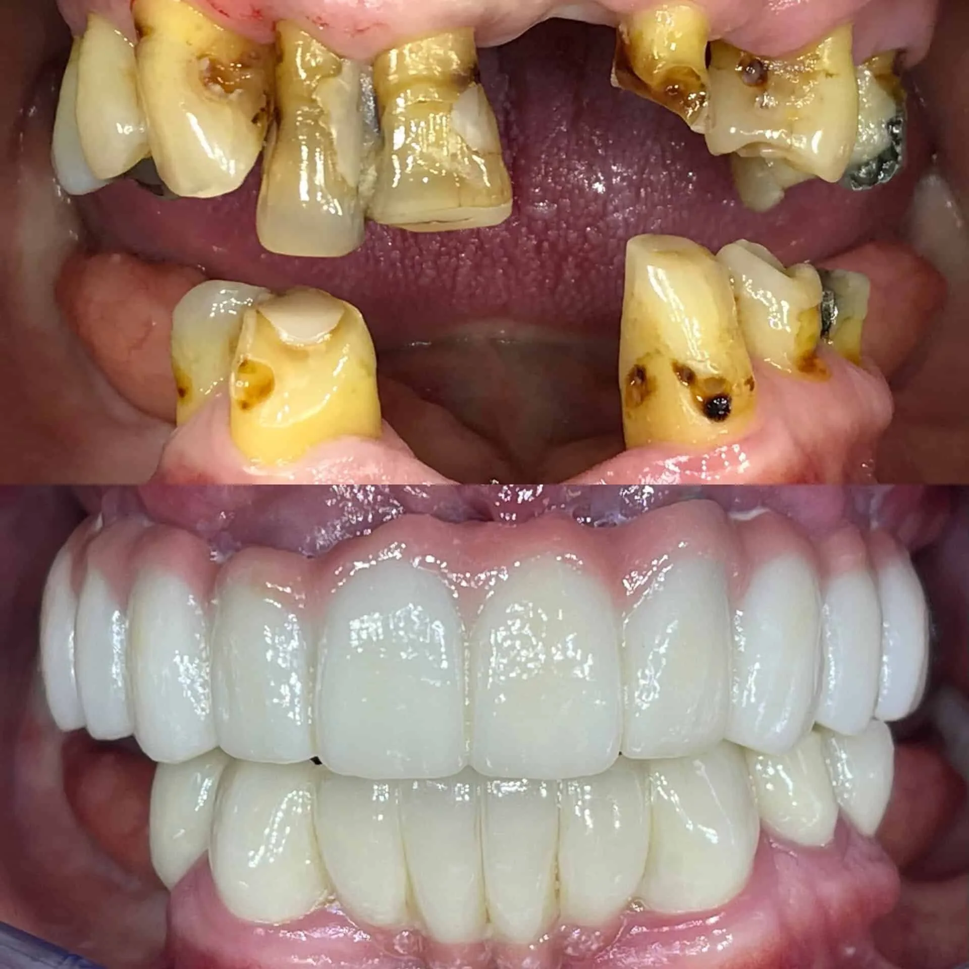 All on four before and after dental implants