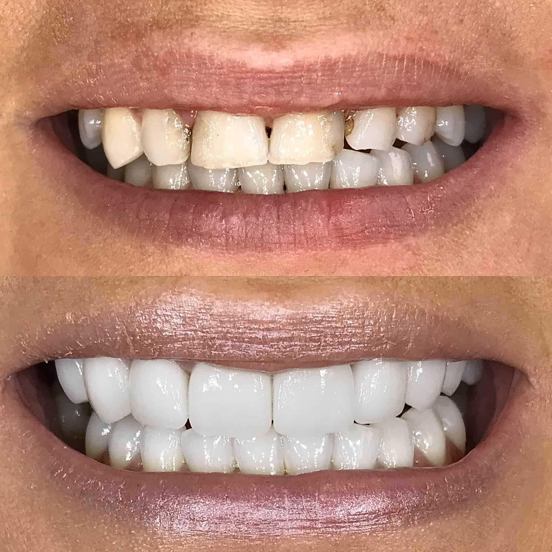 all on four dental implants before and after 3