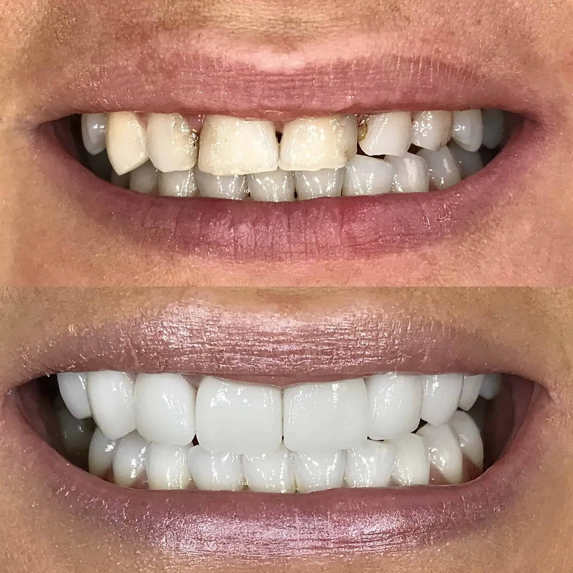 all on four dental implants before and after 3