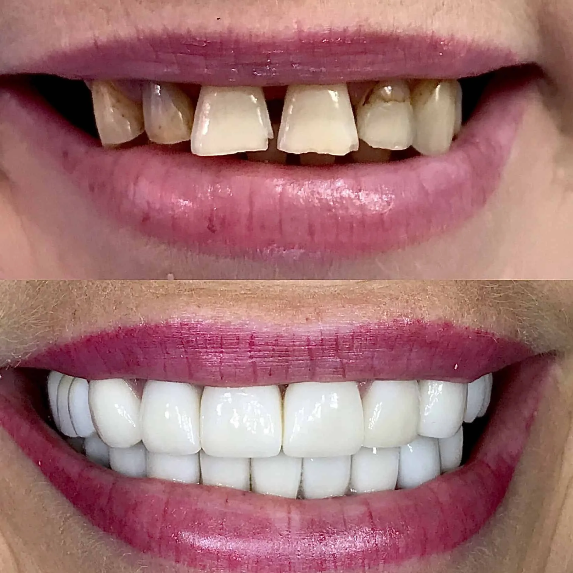 all on four dental implants before and after female