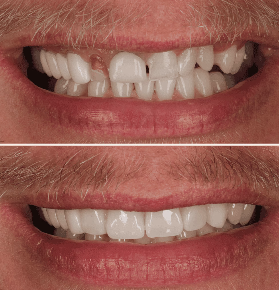 Composite bonding before and after 2