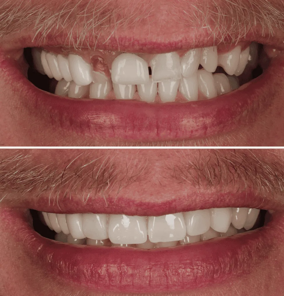 Composite bonding before and after 2
