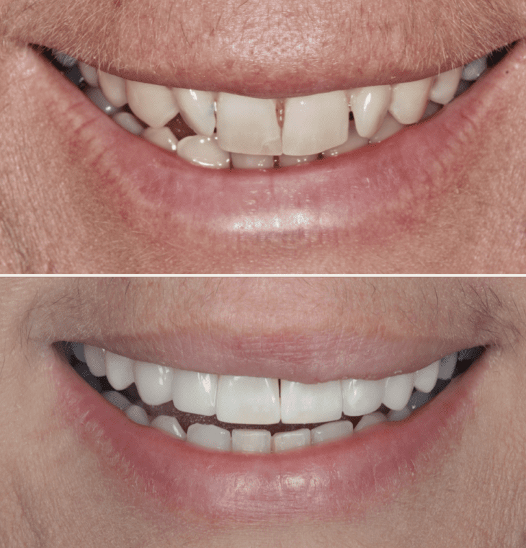 Learn About Our Dental Composite Bonding Beyond Dental