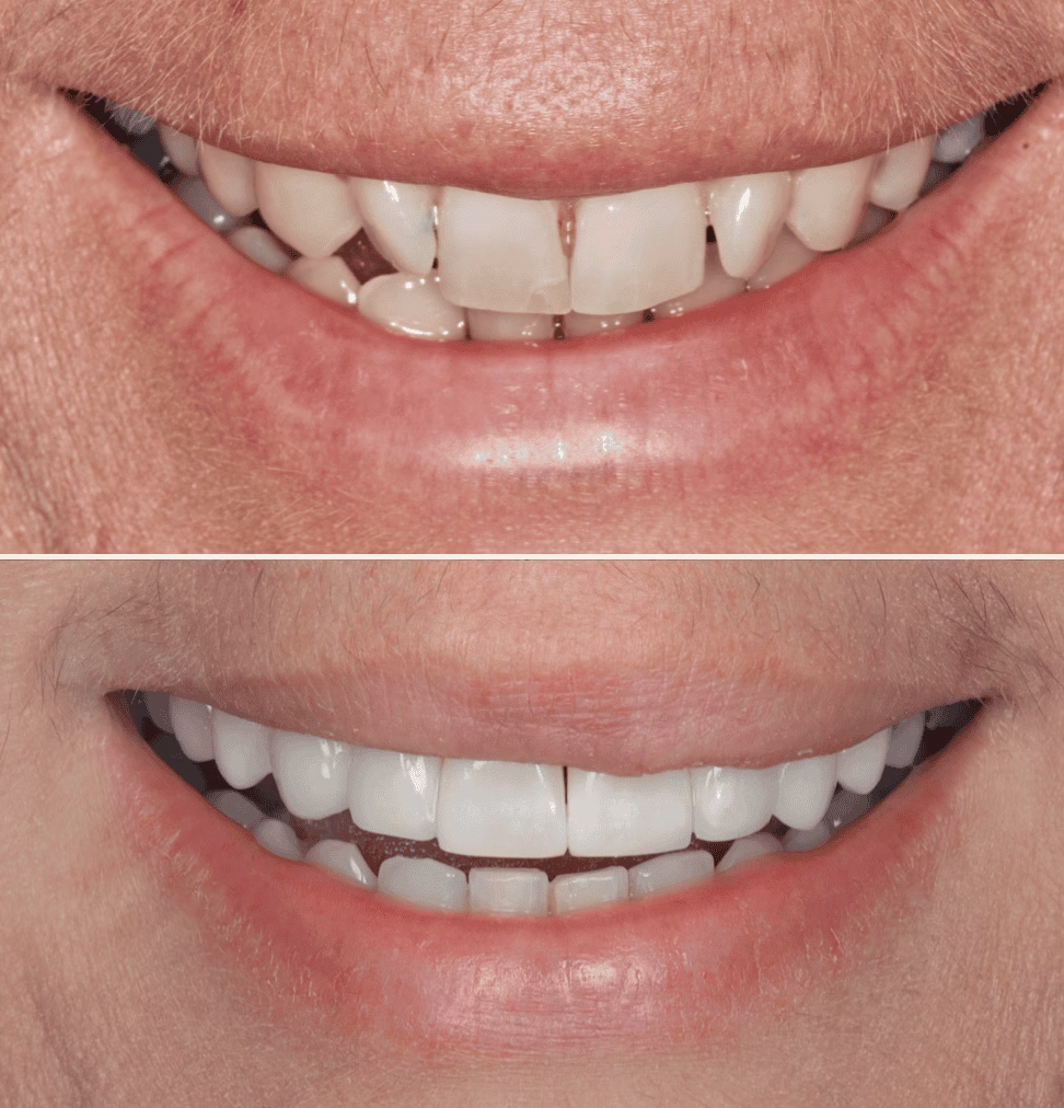 Composite bonding before and after 5