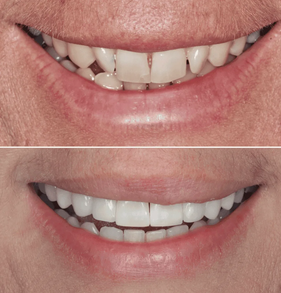 Composite bonding before and after 5