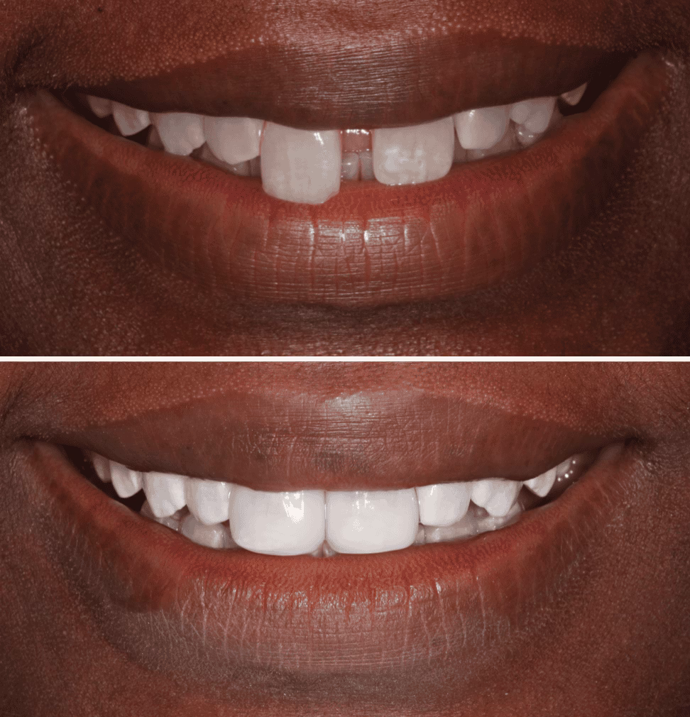 Composite bonding before and after 4