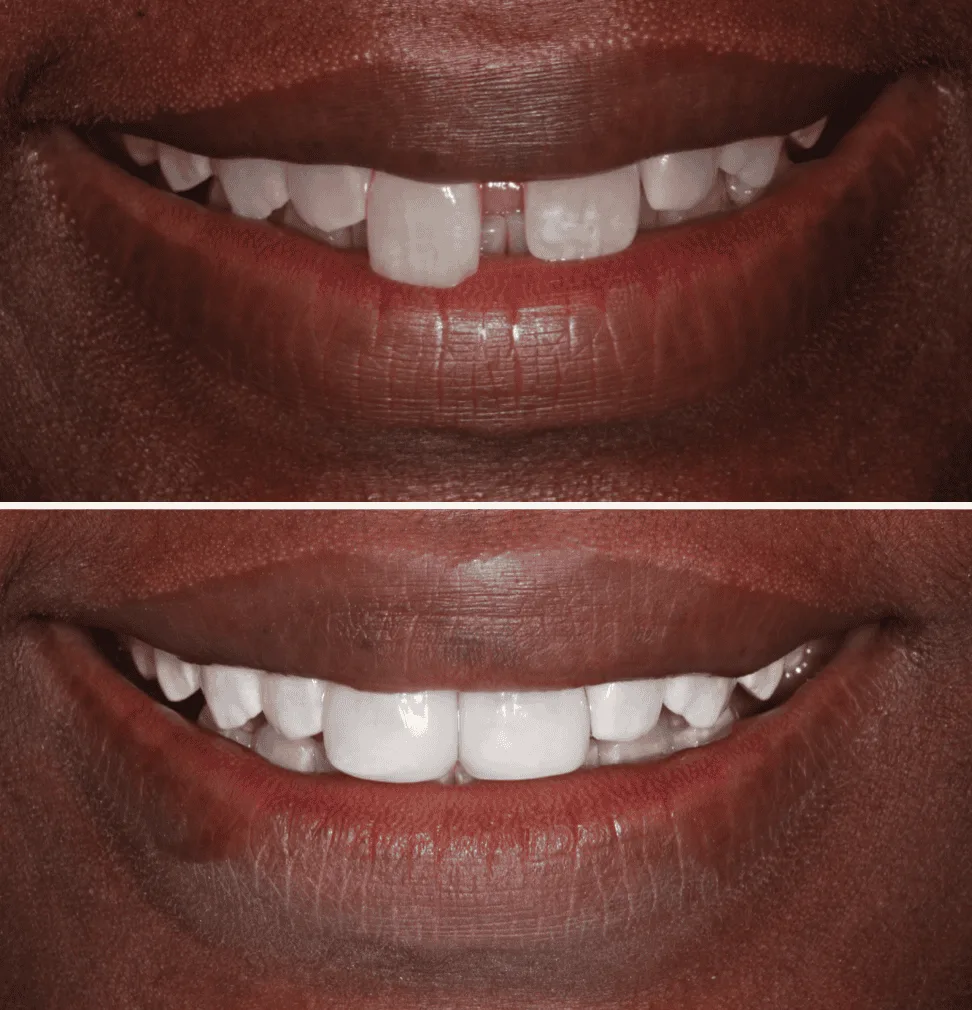 Composite bonding before and after 4