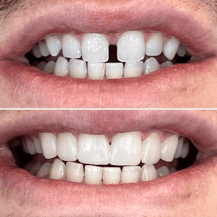 Composite Bonding before and after 6