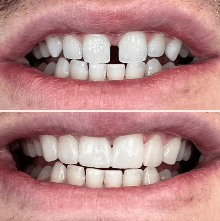 Composite Bonding before and after 6