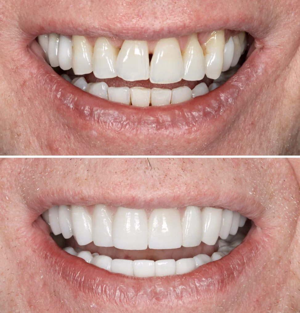 Invisalign-Before-and-after-4