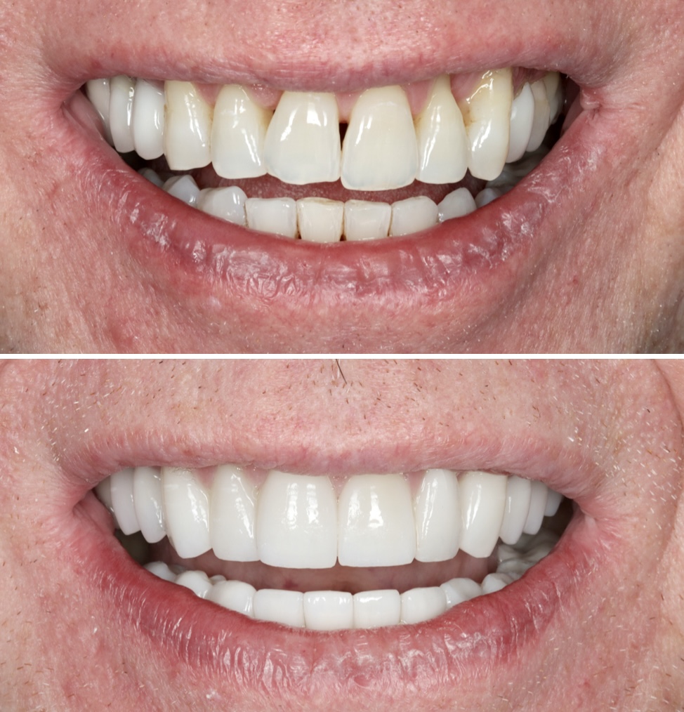 Invisalign Before and after 4 - Beyond Dental