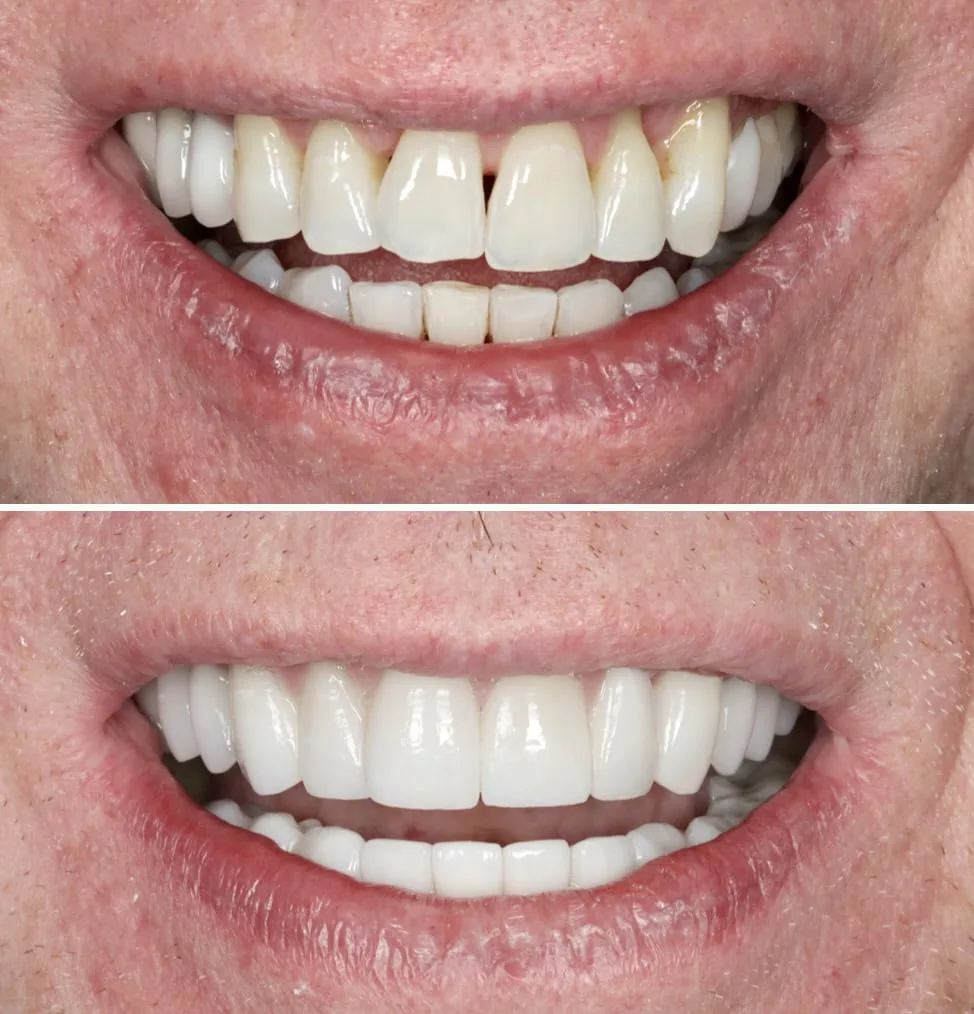Invisalign-Before-and-after-4