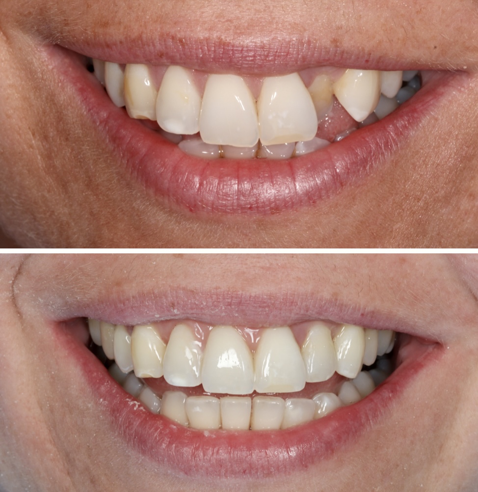 Invisalign before and after 2 Beyond Dental