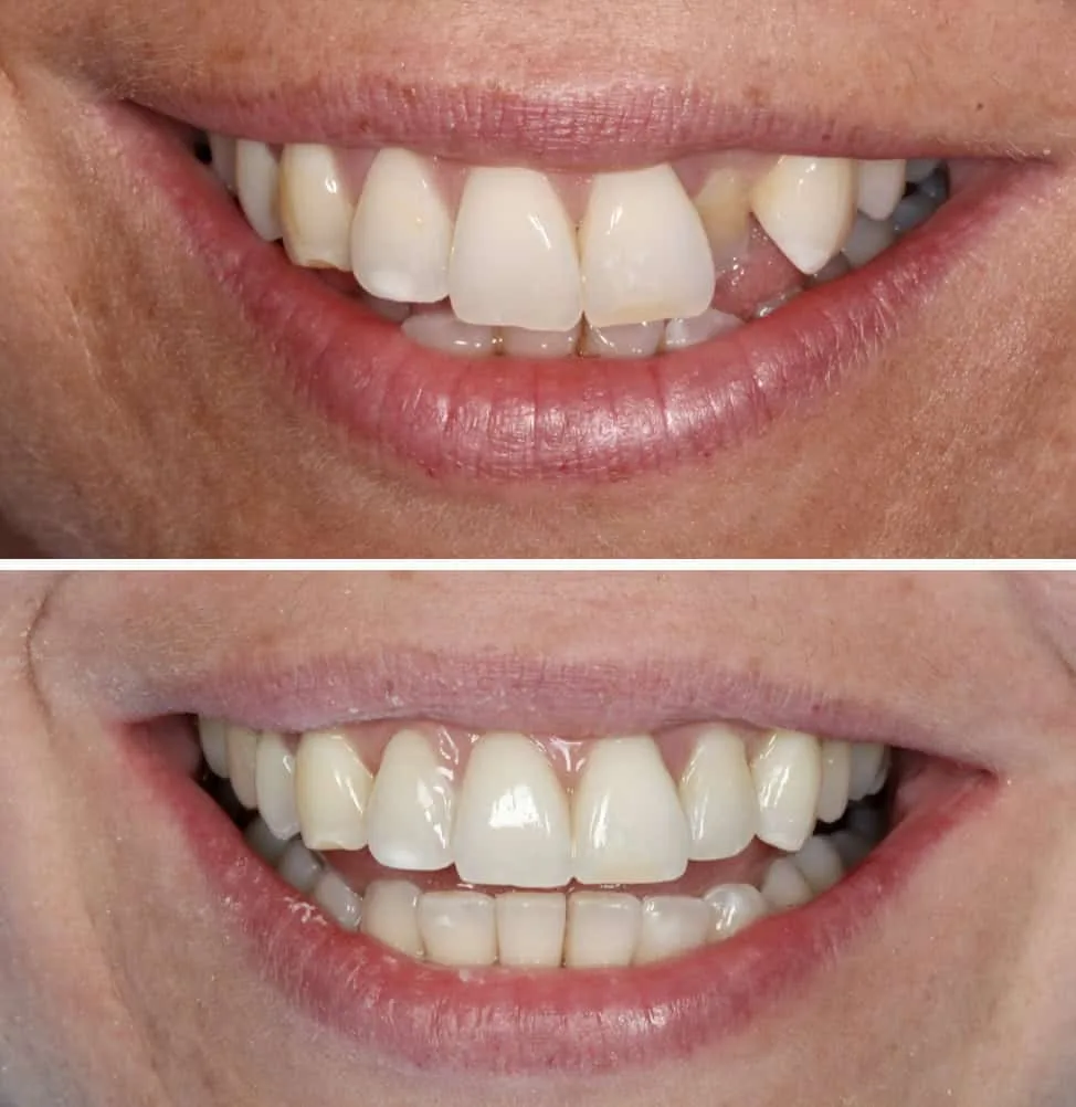 Invisalign-before-and-after-2