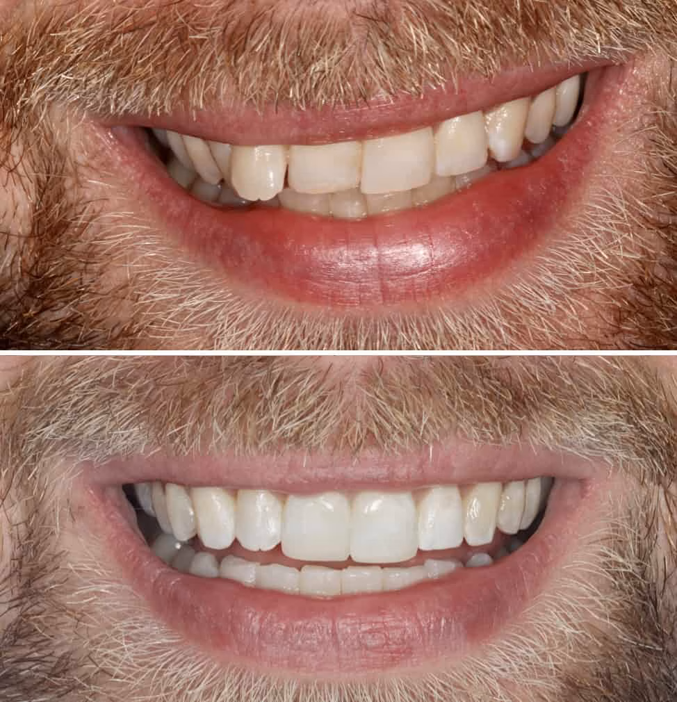 Invisalign-before-and-after-5