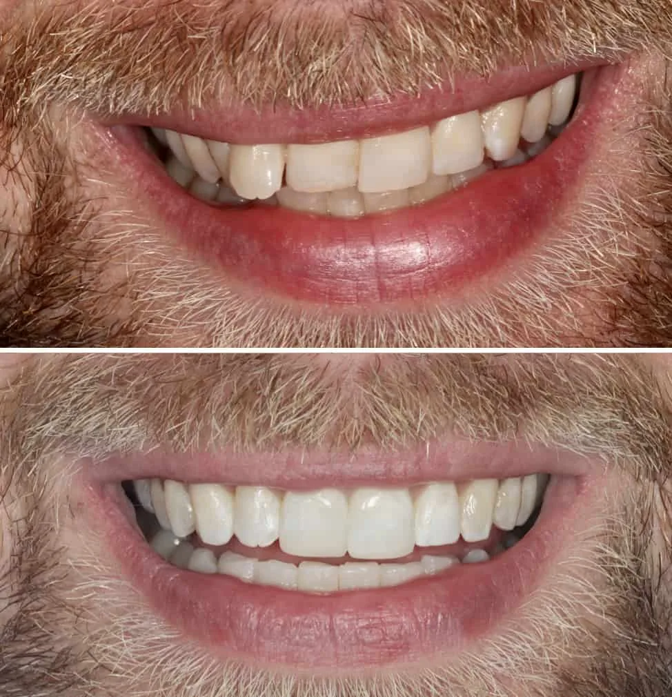 Invisalign-before-and-after-5