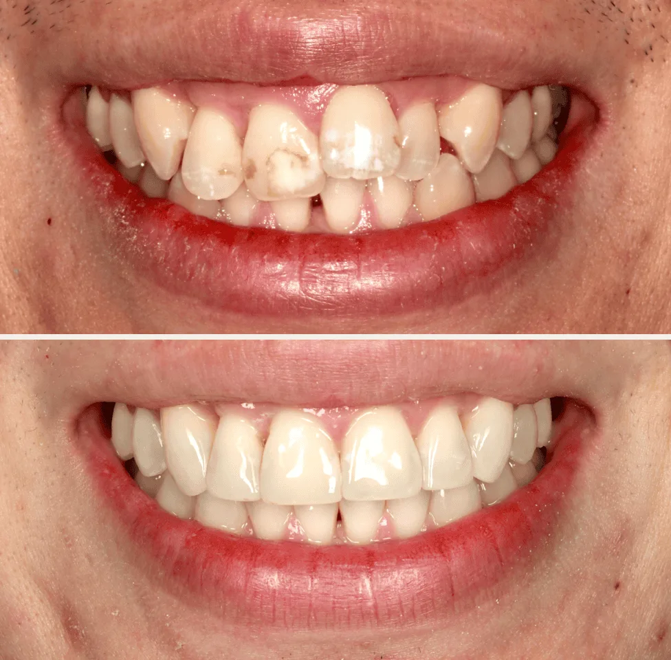 Invisalign before and after solihull