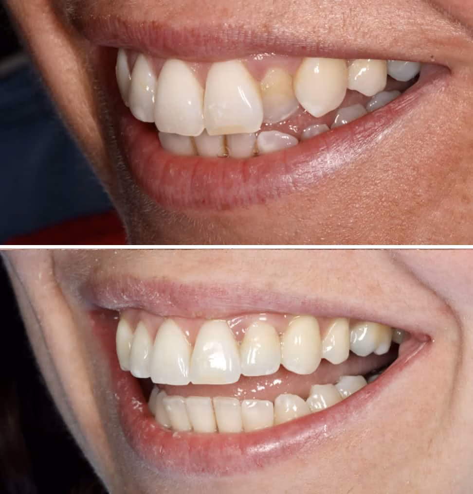 Invisalign before and after 6