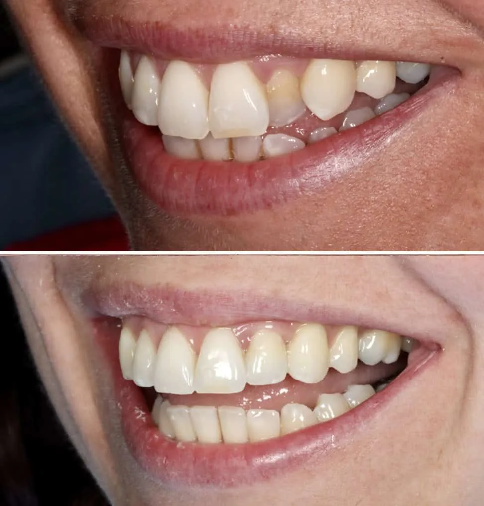 Invisalign before and after 6