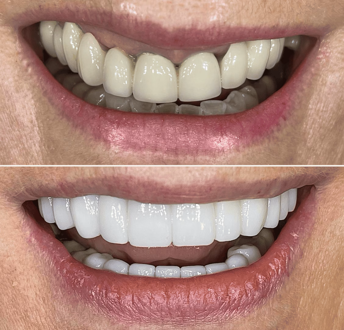 All on four dental implants case study