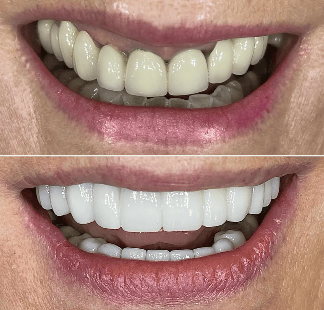 All on four dental implants case study