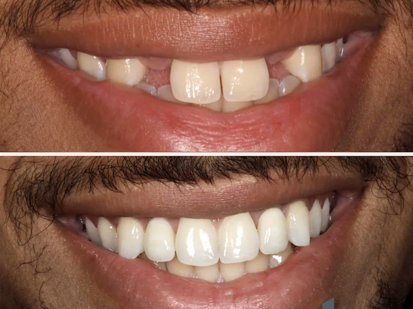 Dental-implant-befoe-and-after