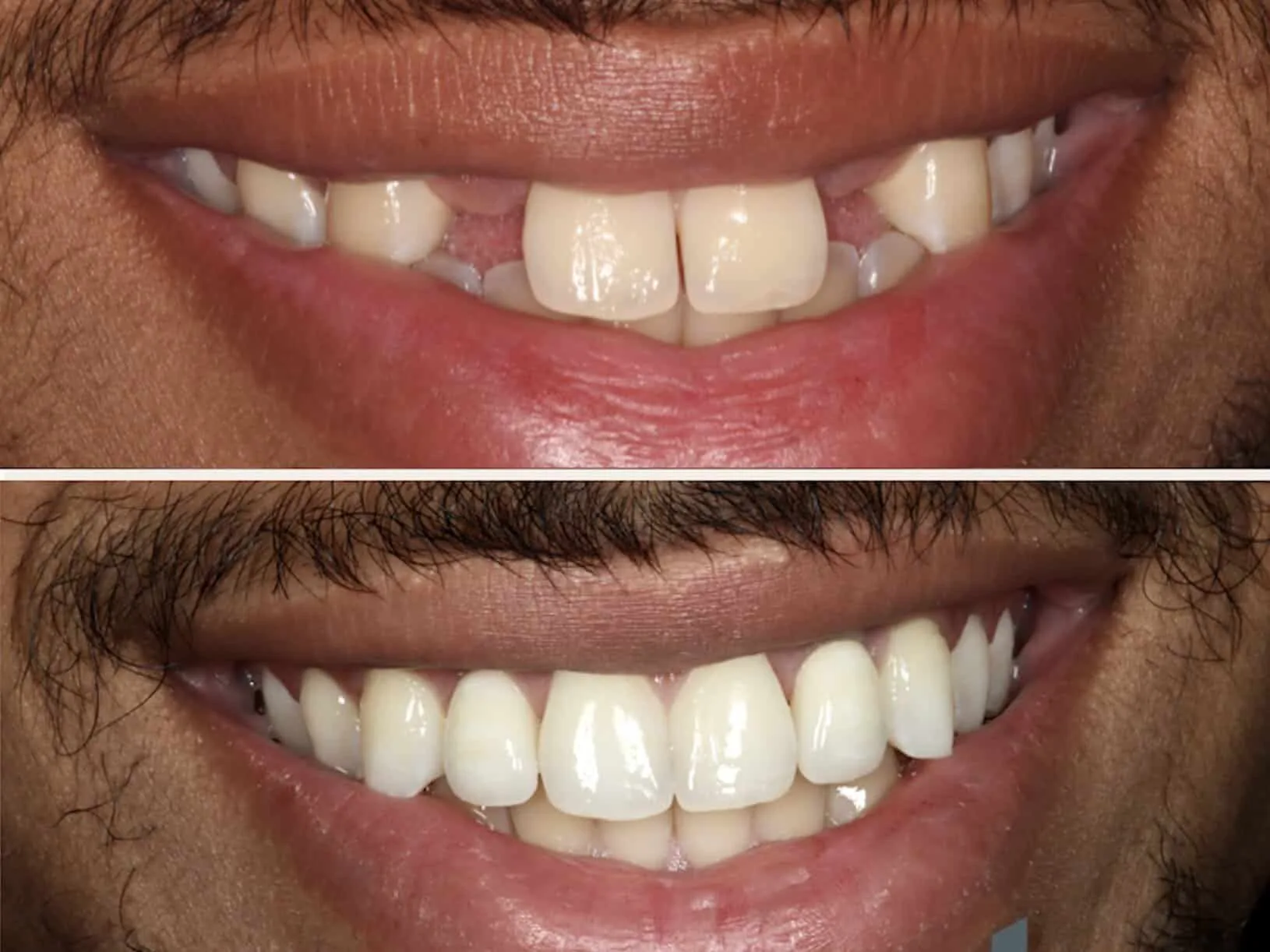 Dental-implant-befoe-and-after