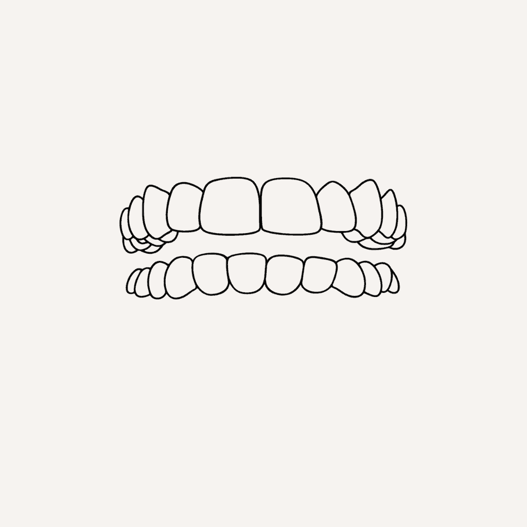 Crowded-Teeth